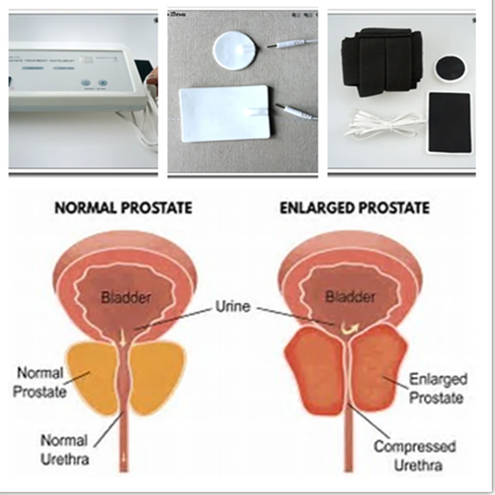 sterilizarea din prostatită probleme de urinare