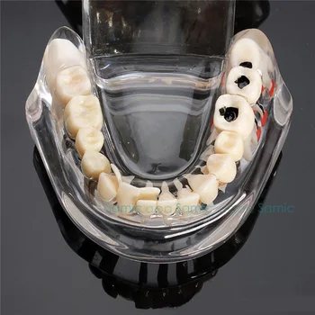1buc Implant Dentar Boli de Dinți Model Cu Restaurarea Podului Dinte la Dentist Pentru Știința Medicală Dentară Boala de Predare Studiu